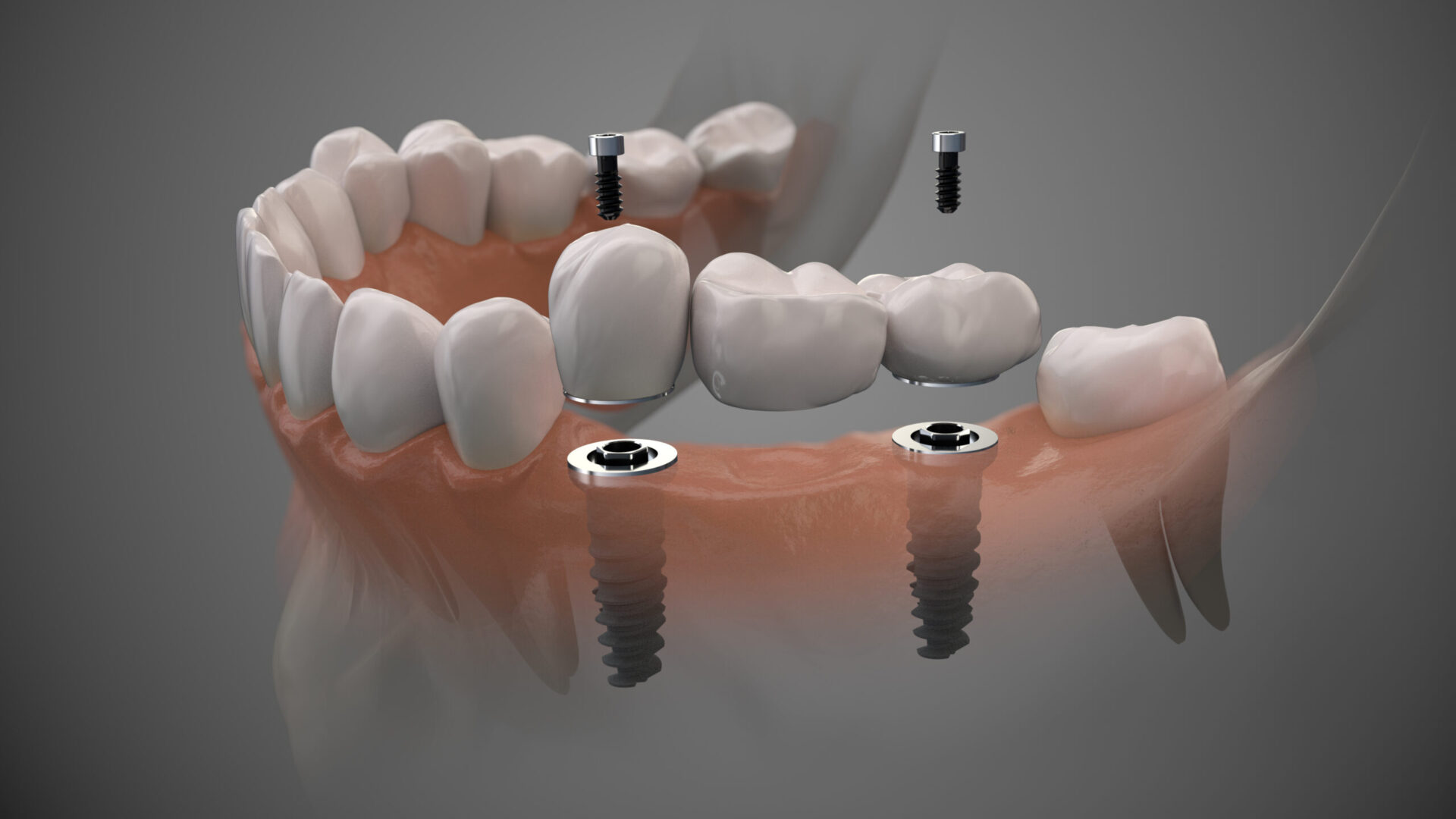 Tooth bridge human implant