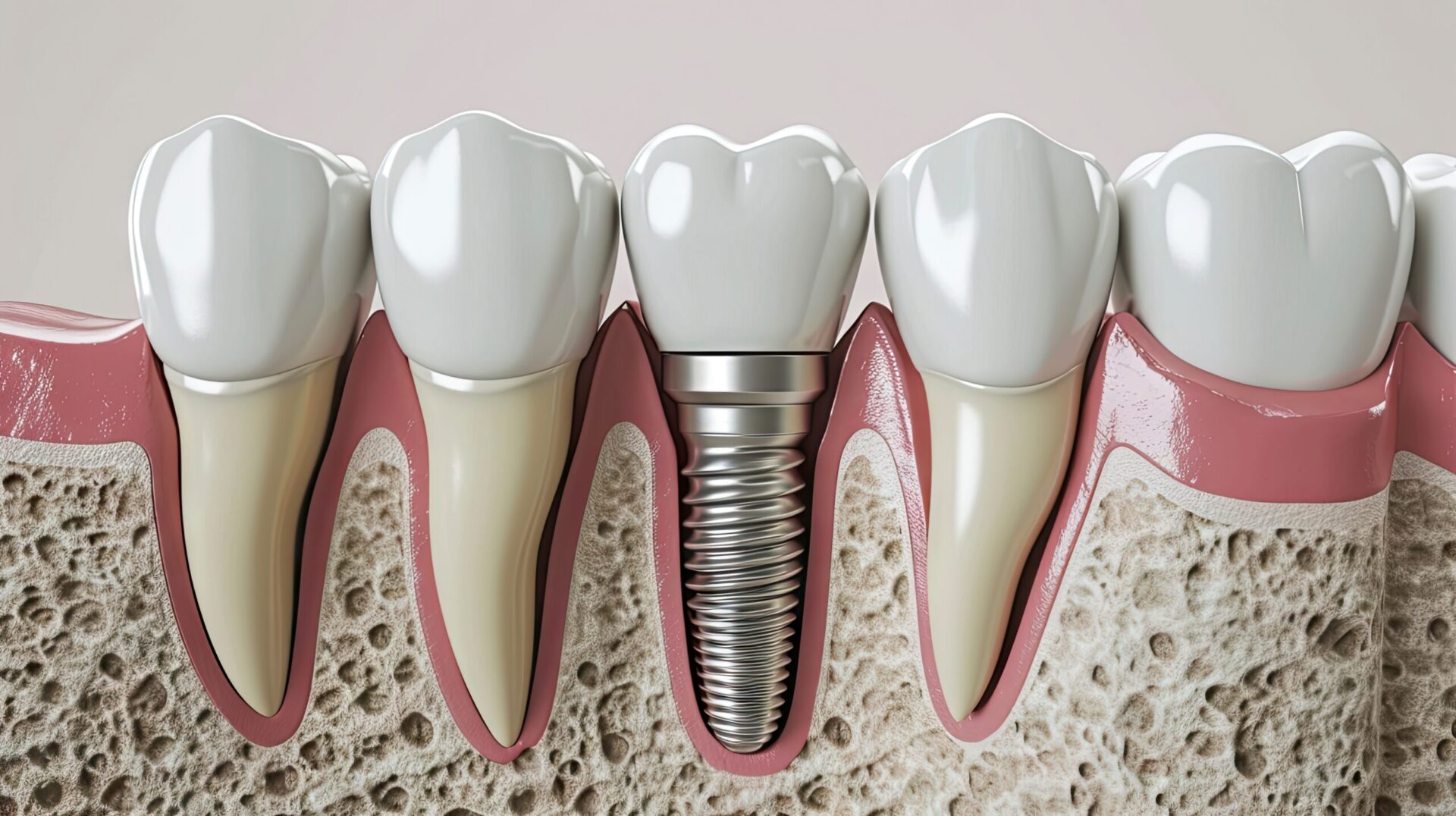 Dental Implant