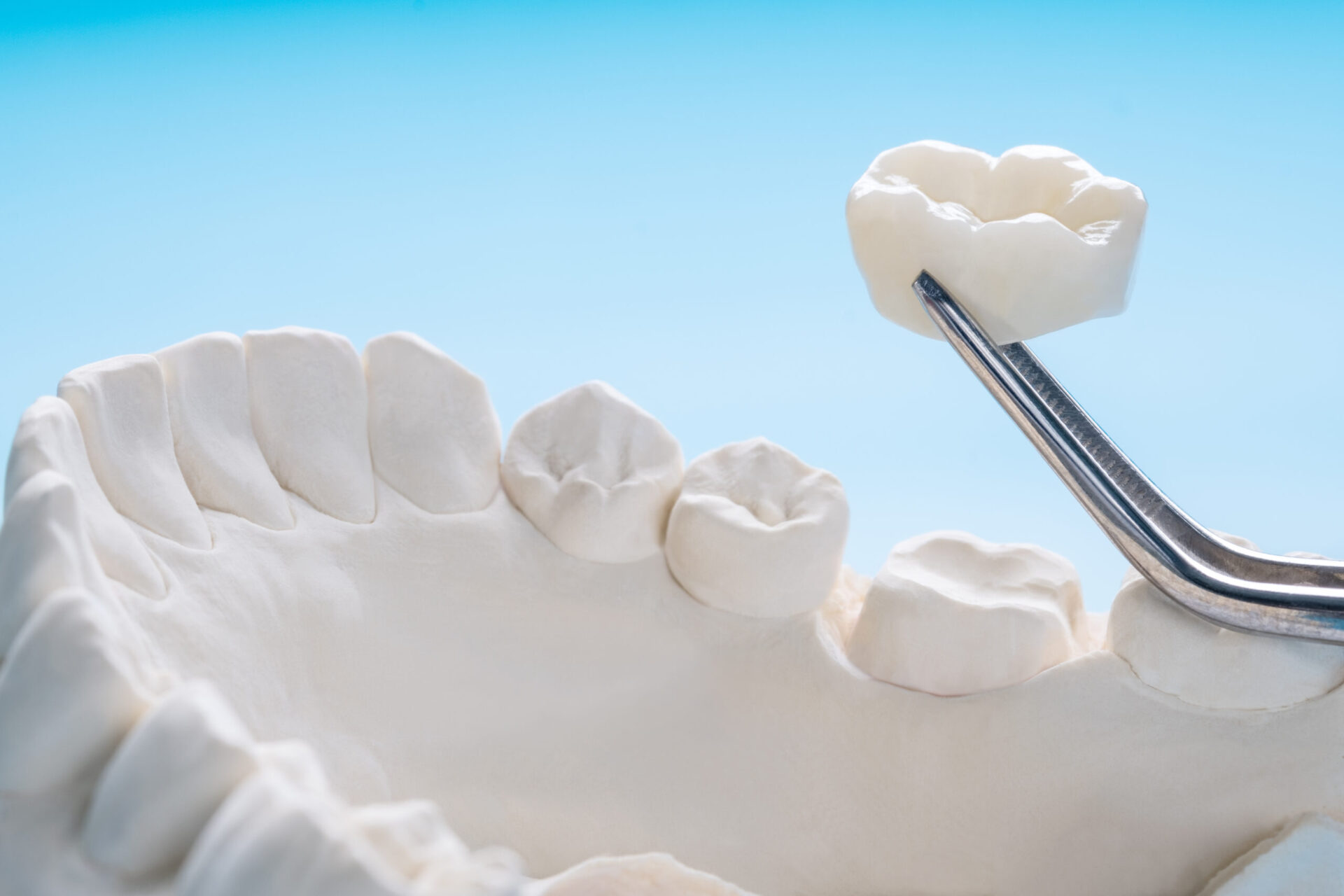 Tooth Implant
