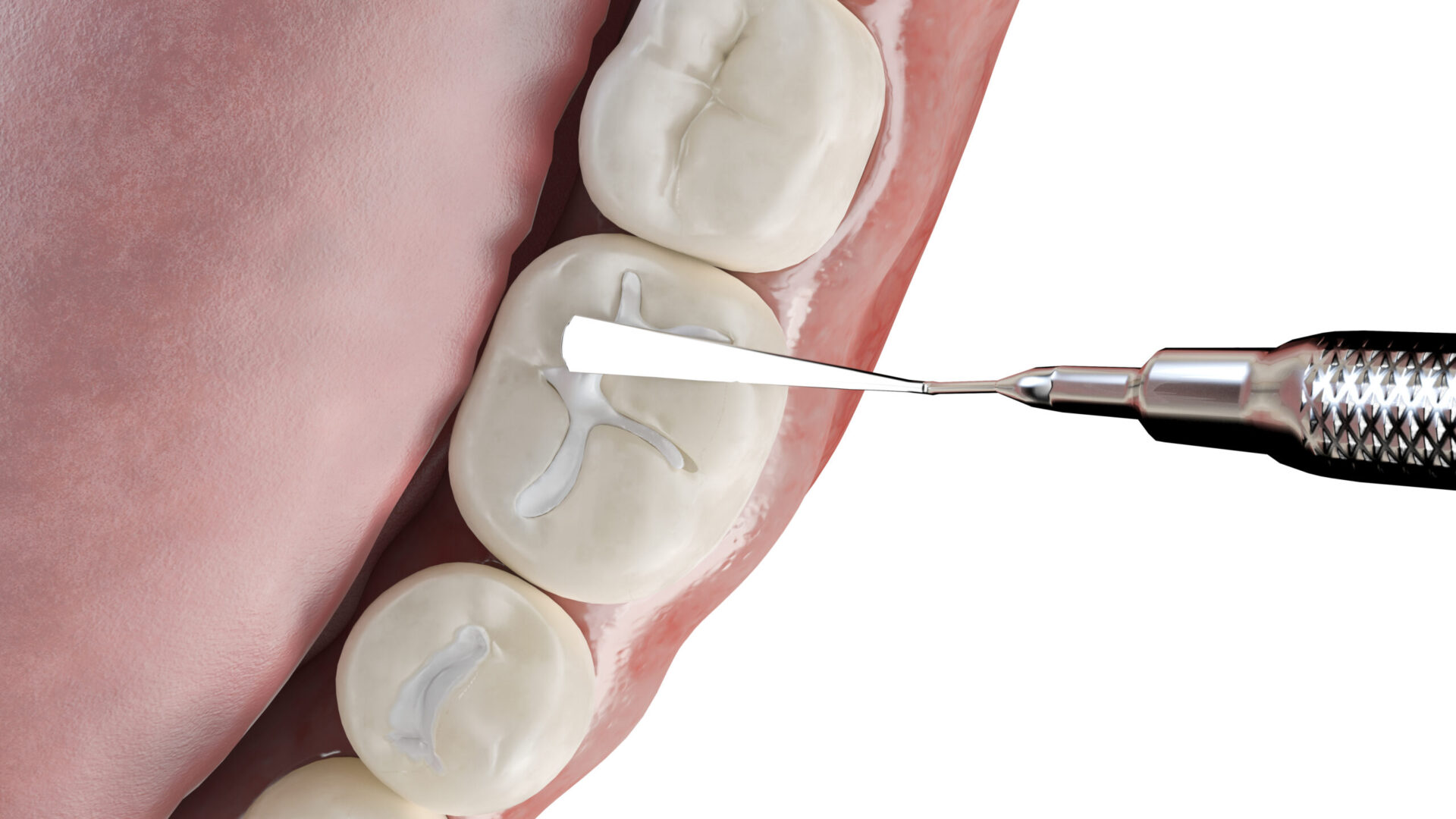 3d rendered illustration of a dental fissure filling