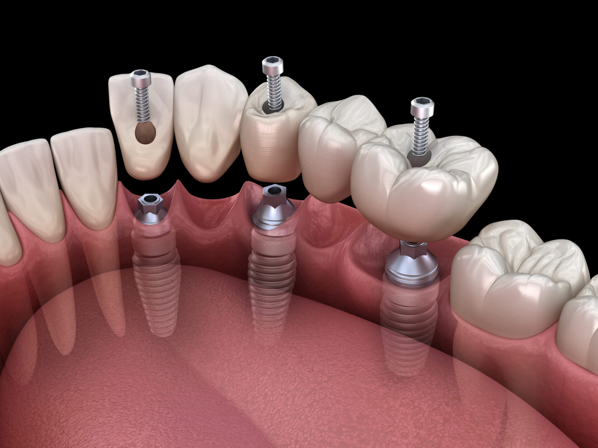 Dental Implants