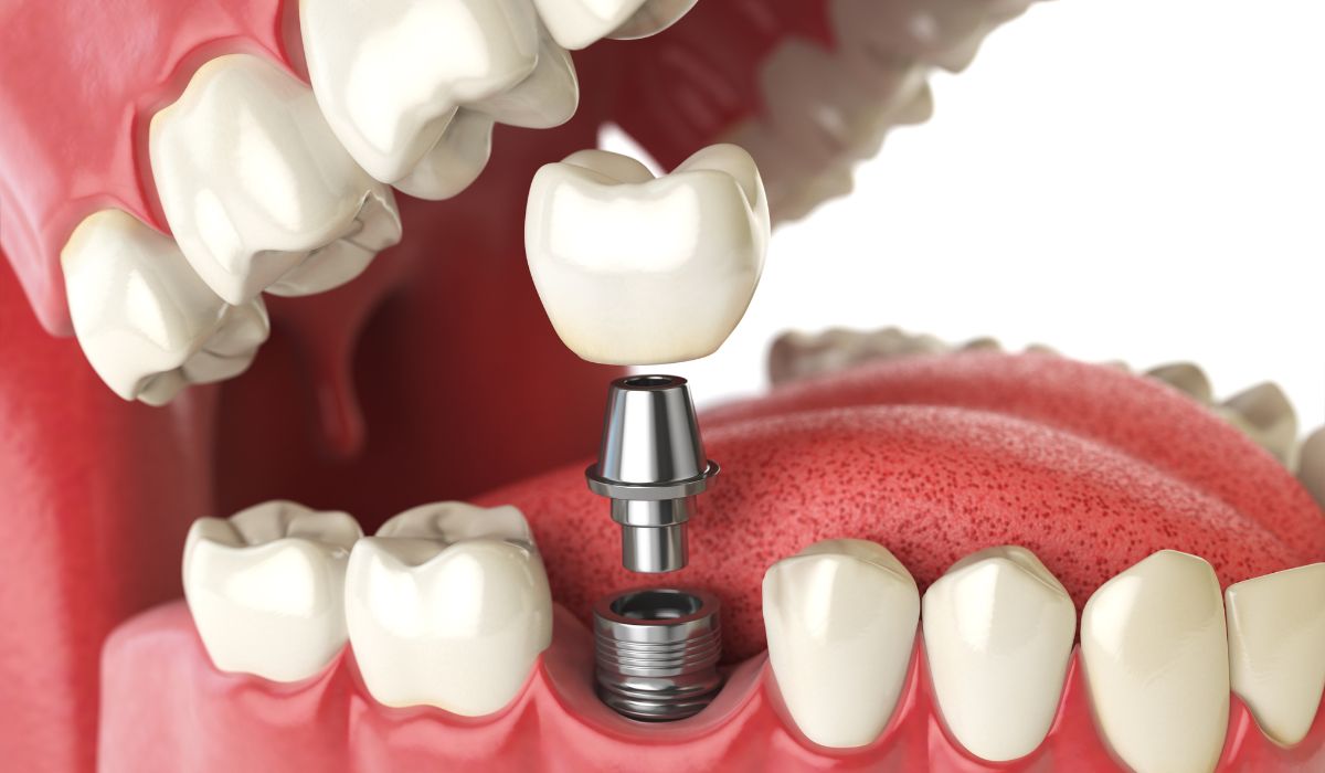 Dental Crown Cost at Hesed Dental Clinic