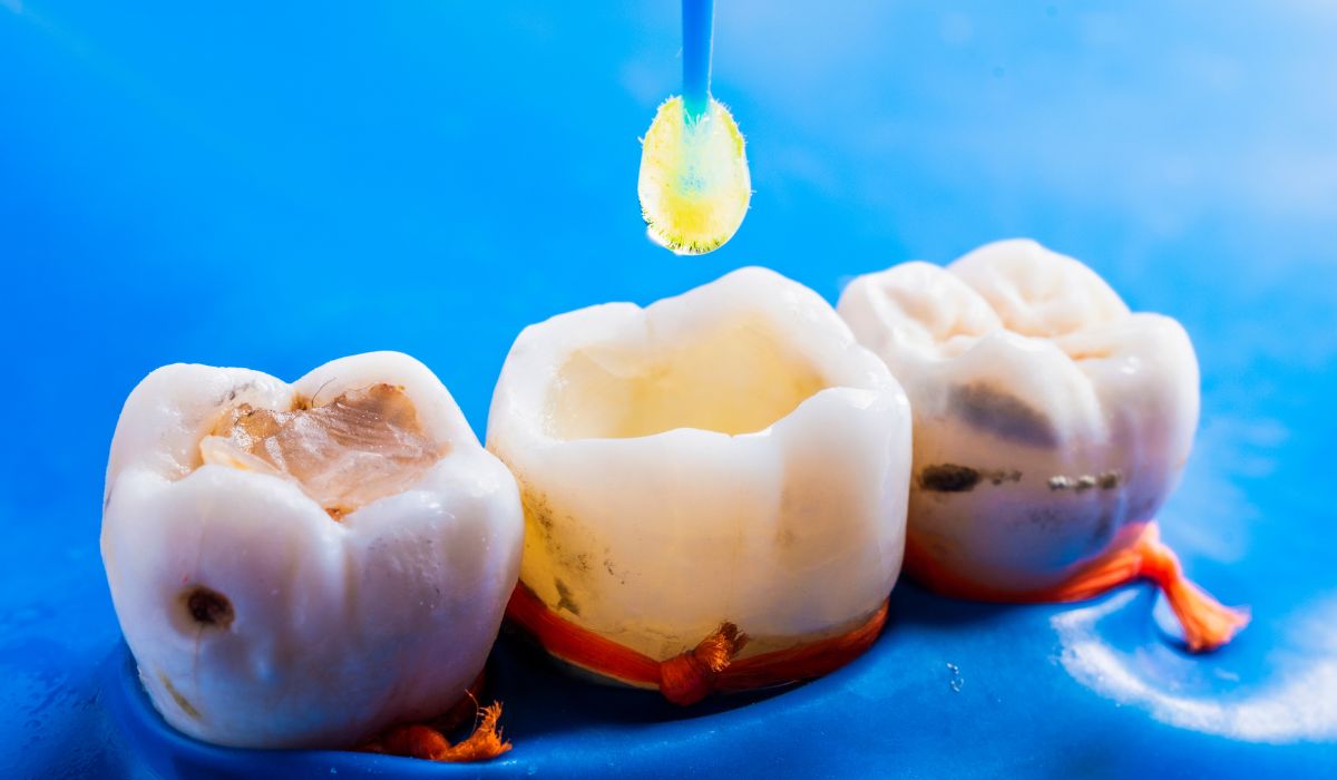 What are Composite Dental Fillings