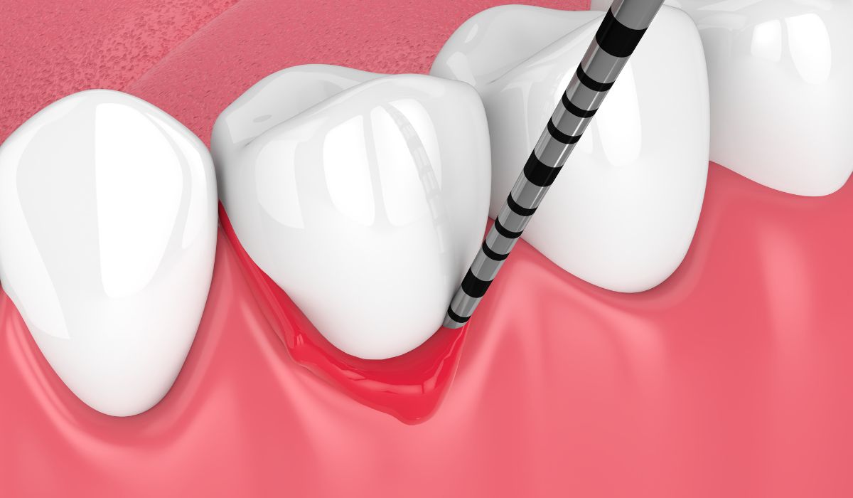 Link Between Diet And Periodontal Diseases