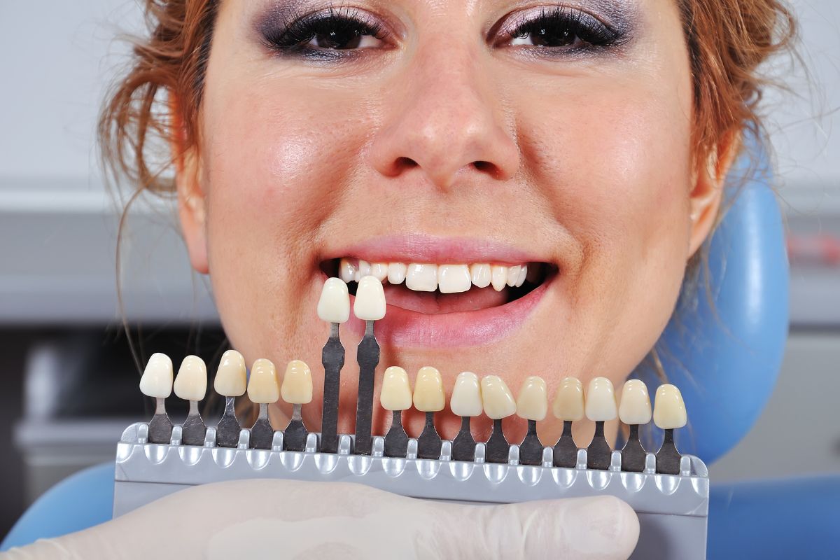 Are Veneers Worth It