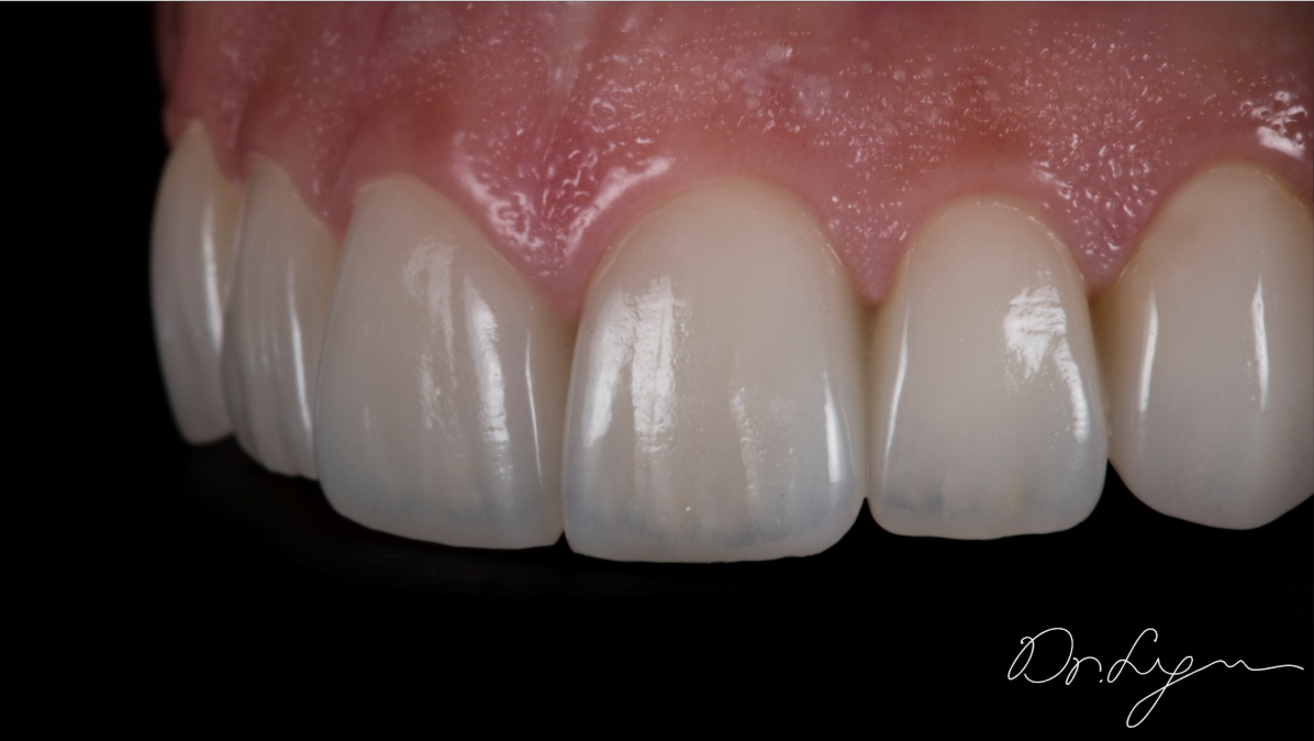 The Veneer Blue Print — Clinical Course